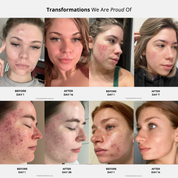 COMPLETE ACNE TRANSFORMATION KIT.